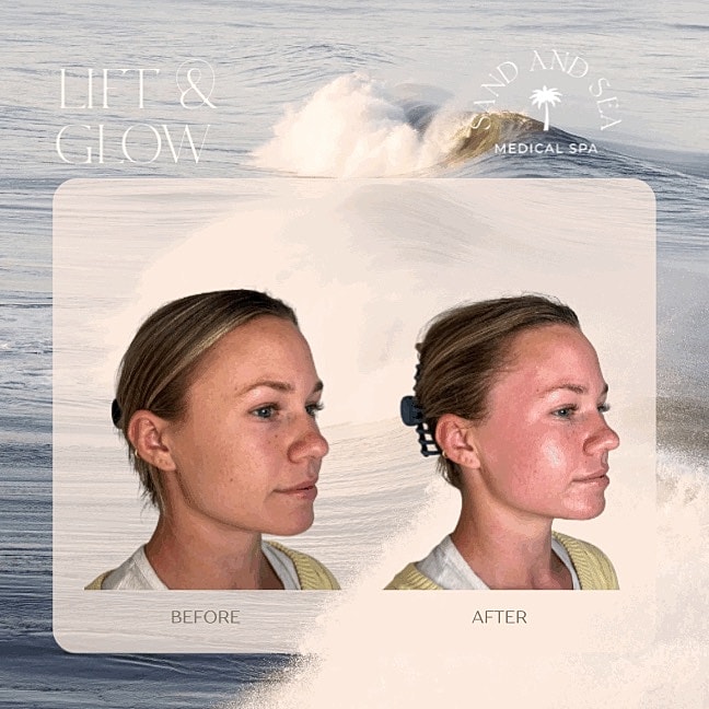 Before and after facial treatment comparison.