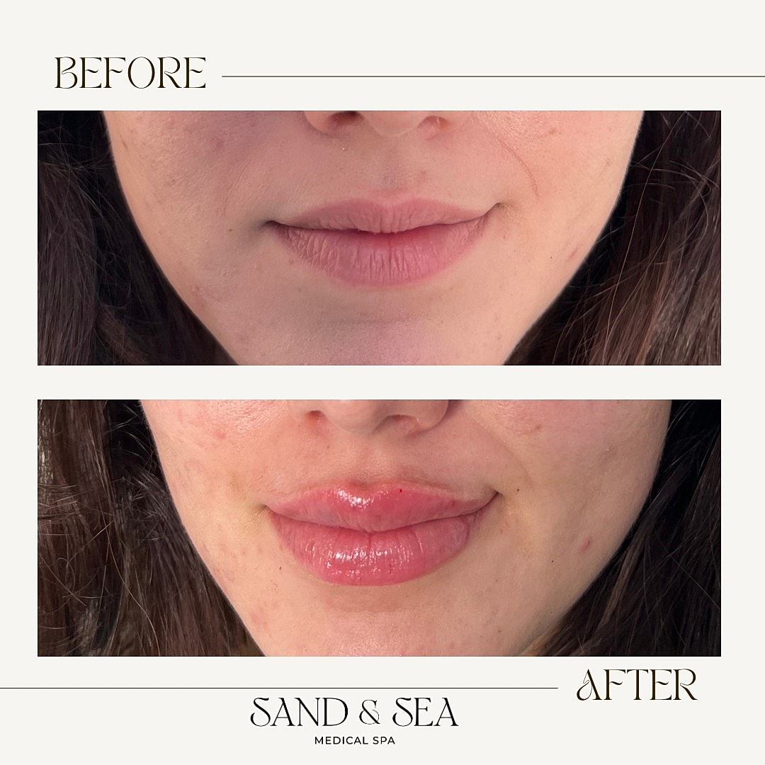 Lip enhancement treatment before and after comparison.