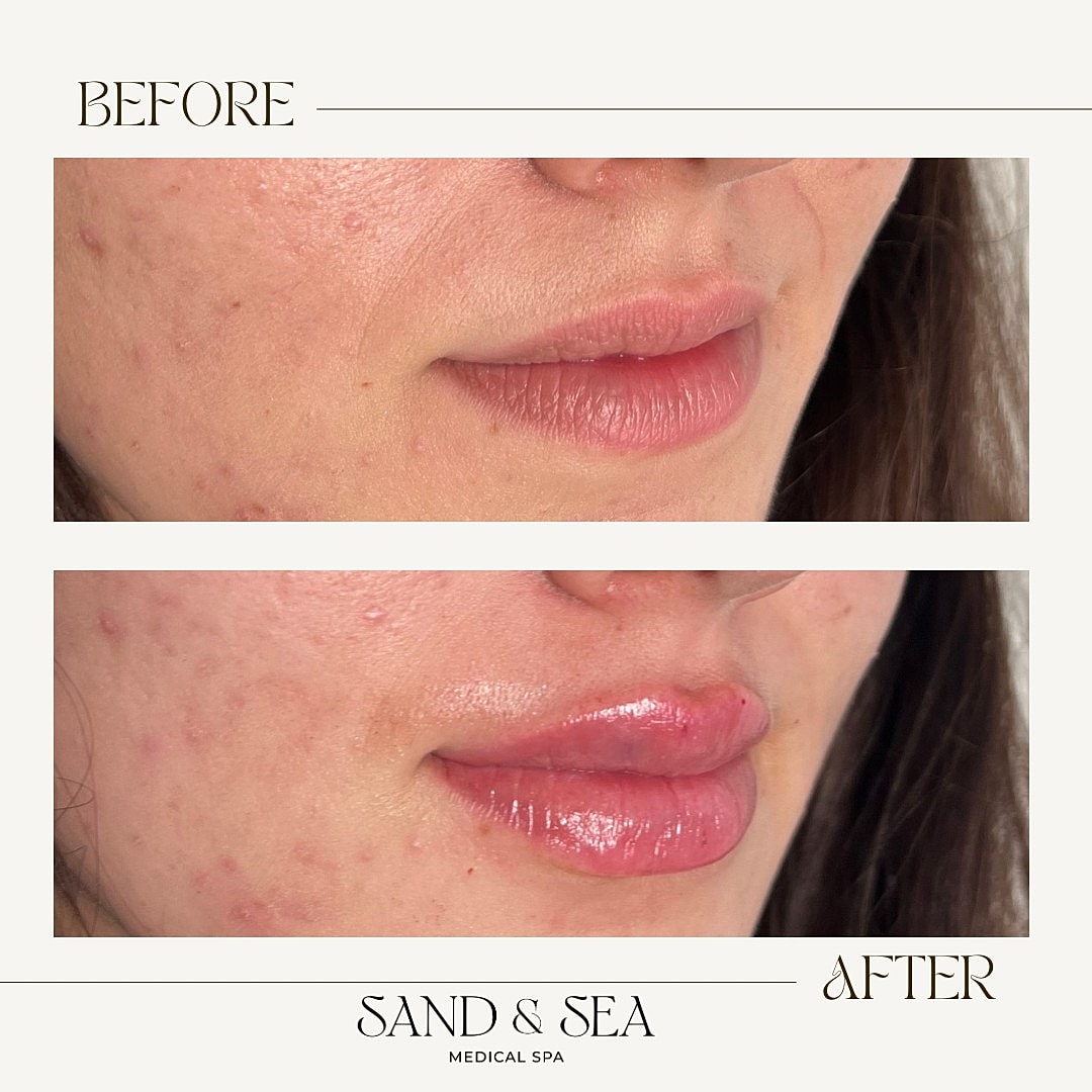 Before and after lip enhancement treatment results.