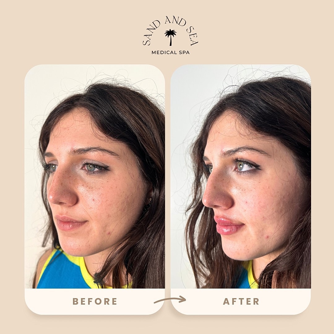 Before and after medical spa treatment comparison.