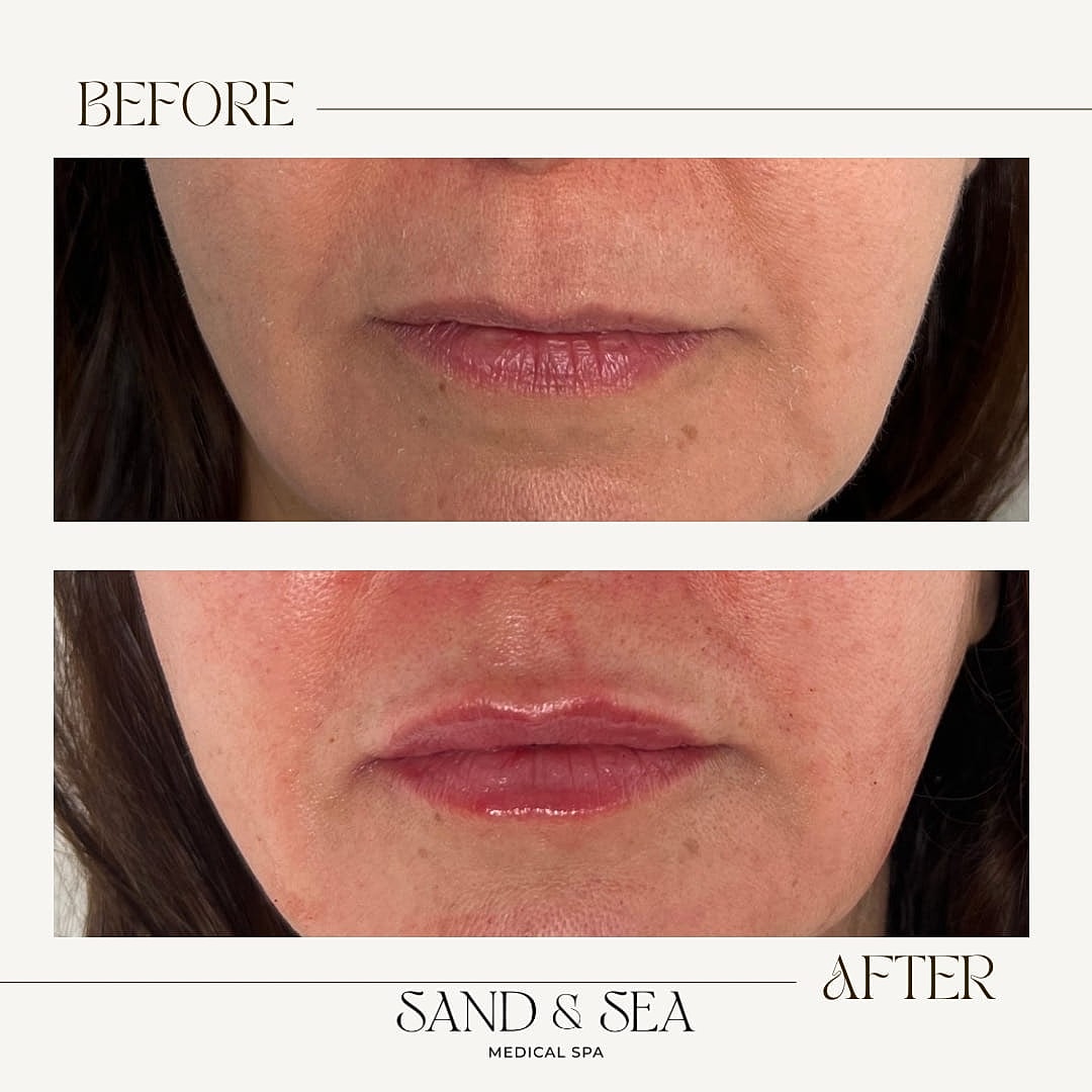 Before and after lip treatment comparison.