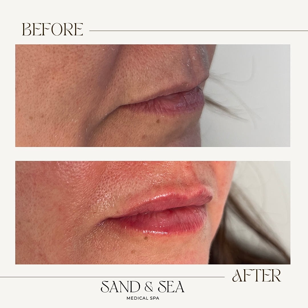Lip enhancement before and after comparison.