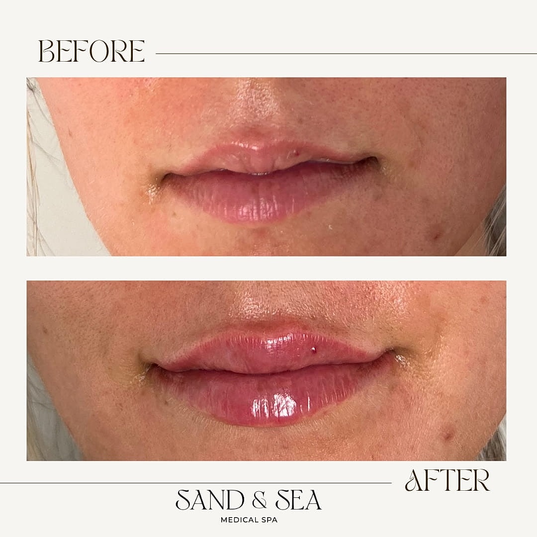 Lip enhancement before and after treatment comparison.