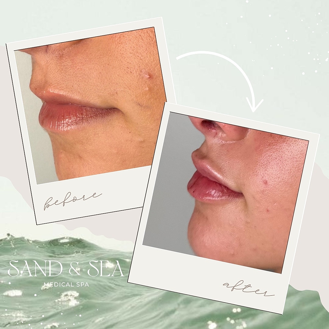 Before and after lip treatment transformation.