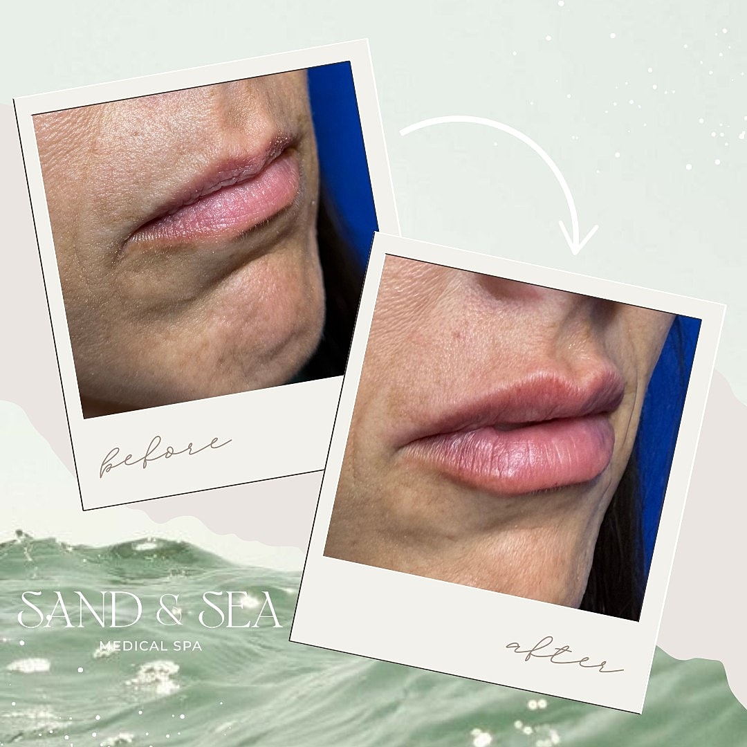 Lip enhancement before and after treatment images.