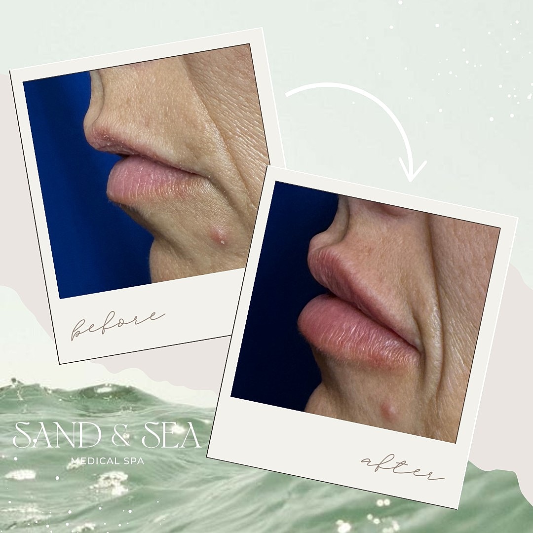Lip enhancement before and after treatment photos.