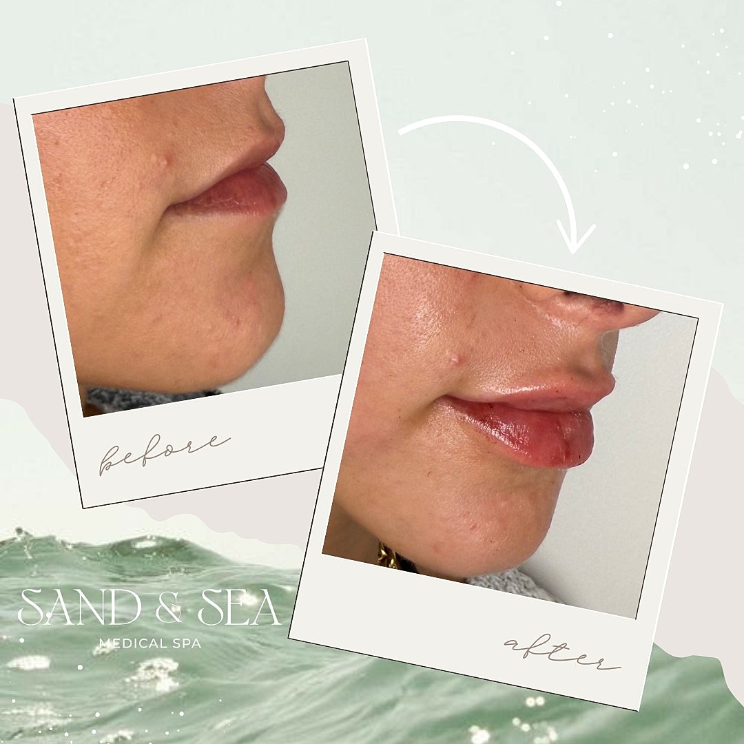 Lip enhancement before and after comparison.