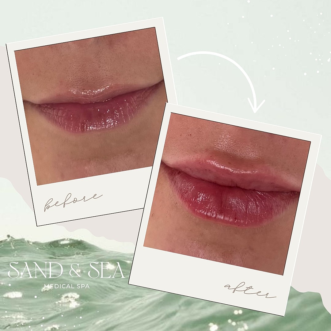 Before and after lip enhancement photos
