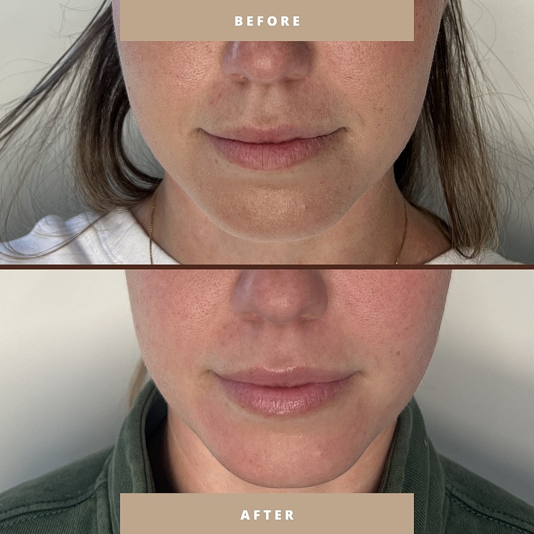 Skin improvement before and after treatment.