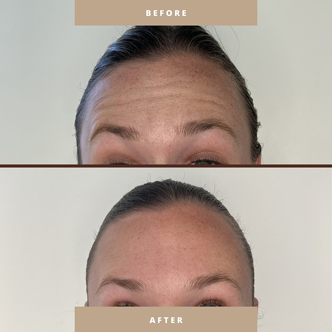 Before and after skin treatment comparison image.