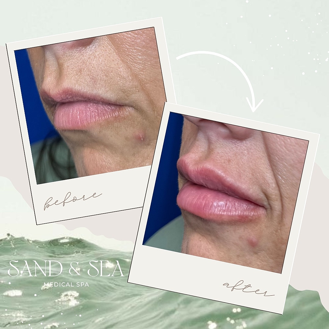 Before and after facial skin treatment comparison.